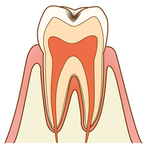 エナメル質の虫歯