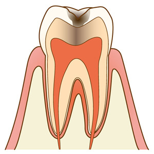 神経に近い虫歯