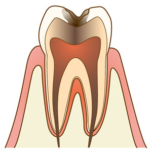 神経に到達した虫歯