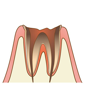 末期の虫歯